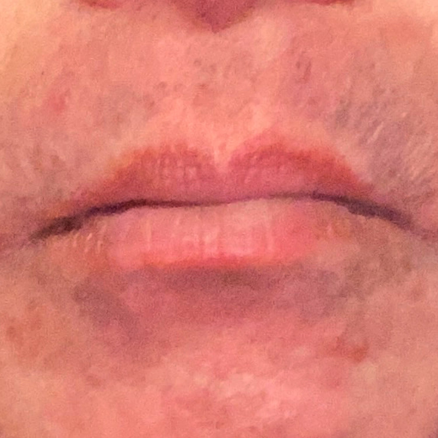 カミソリ負けをし、「剃らない」日の1日目って、肌が痒いんです。(僕の場合)カミソリ負け第2章